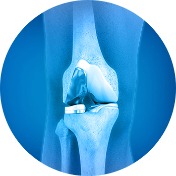 Partial Knee Replacement